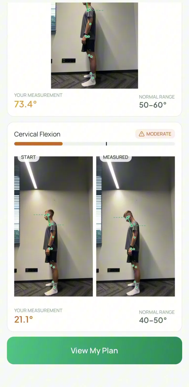 Cervical flexion measured at 21.1 degrees against a 40–50 degree normal range